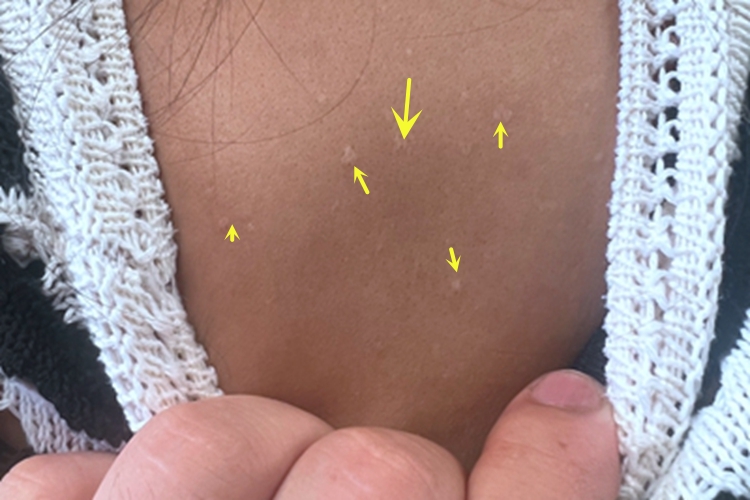 扁平疣背部疙瘩图 扁平疣背部疙瘩图