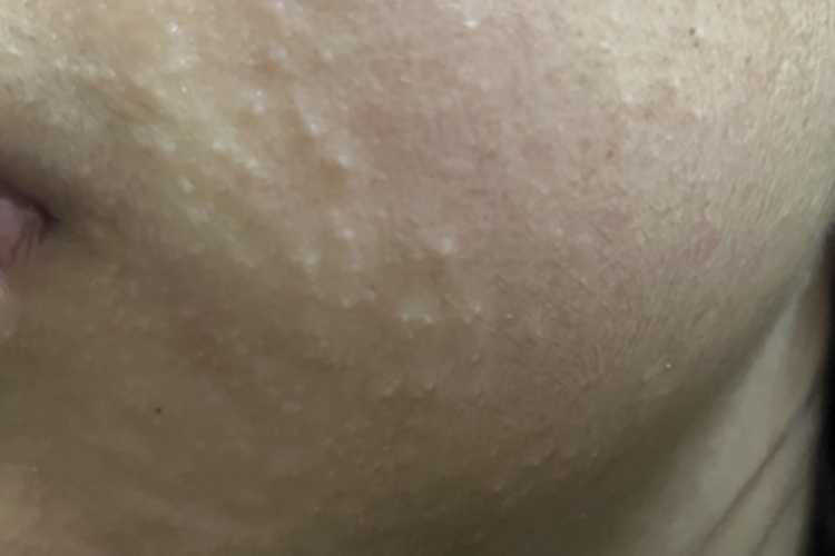 皮炎型化妆品皮炎面部小疹子图