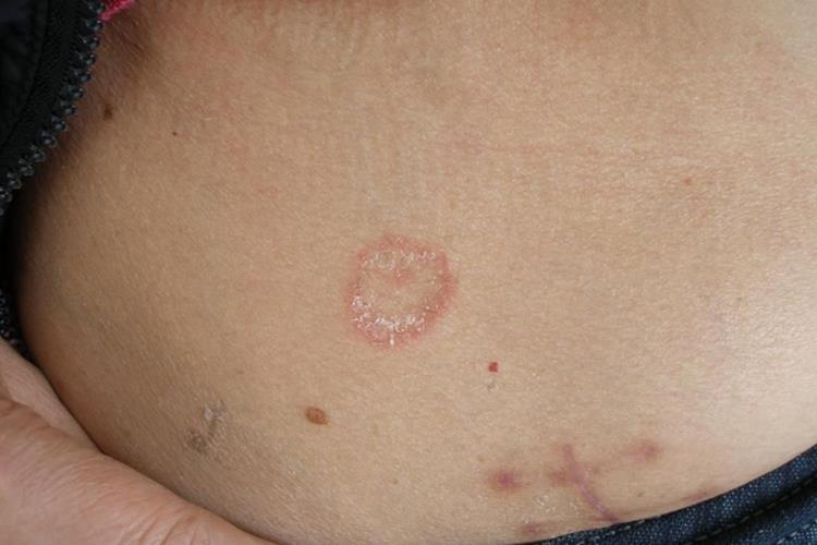 体癣皮肤长结痂样东西图 体癣皮肤长结痂样东西图