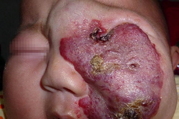 血管角化瘤面部症状图