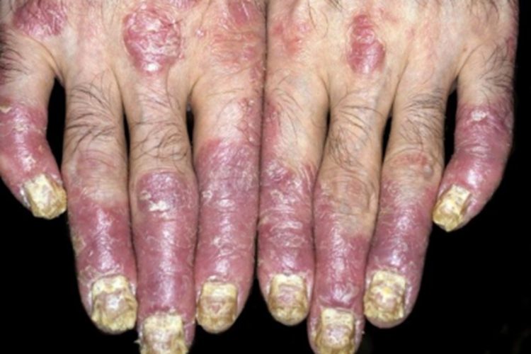 银屑病手部畸形图