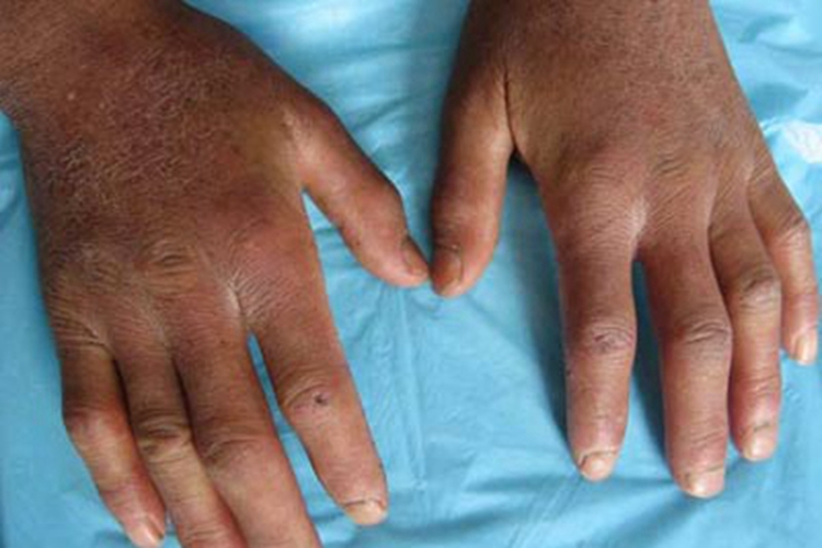 局限性硬皮病手部症状图 局限性硬皮病手部症状图
