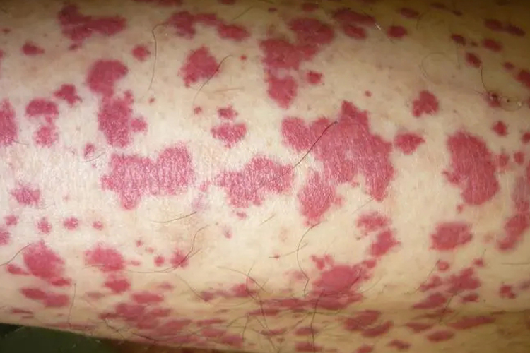 血小板减少性紫癜皮肤瘀斑图