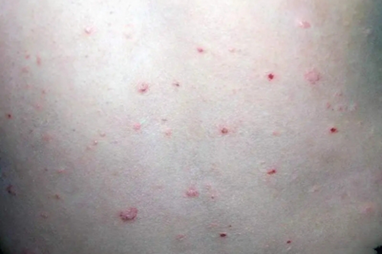 点滴型副银屑病症状图 点滴型副银屑病症状图