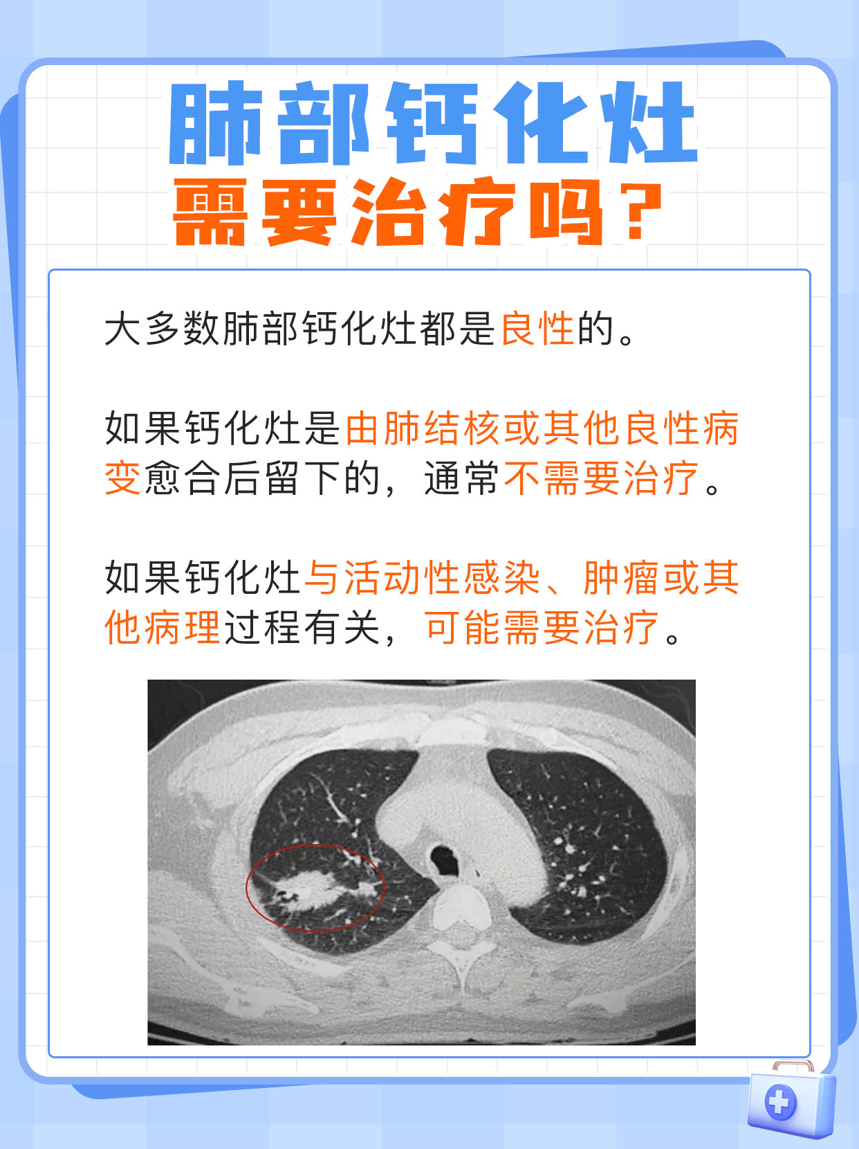 医生解读:肺部钙化灶是否需要治疗
