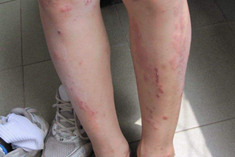 寒冷性多形红斑小腿疙瘩图