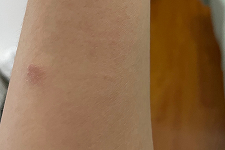 体癣胳膊有红斑起皮图 体癣胳膊有红斑起皮图