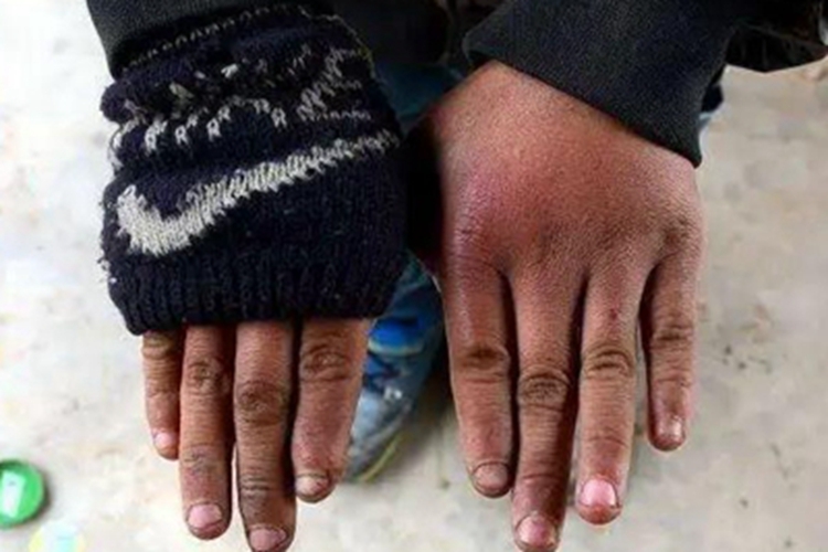 Ⅰ度冻伤手指症状图