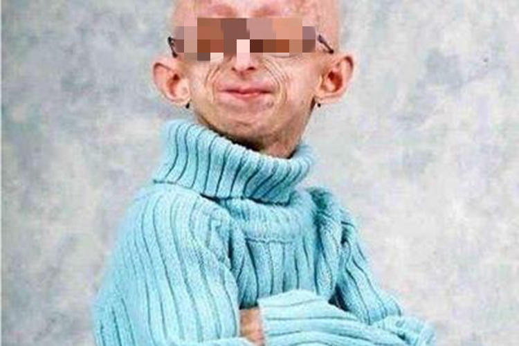 早老症面部纹图 早老症面部纹图