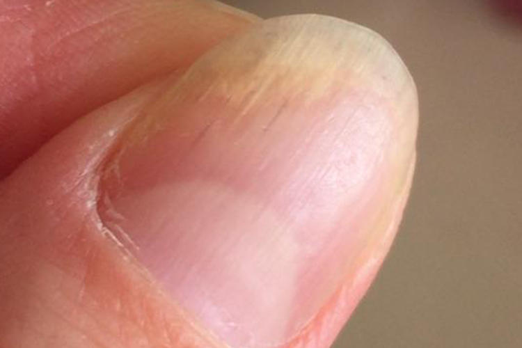 甲母质营养不良图