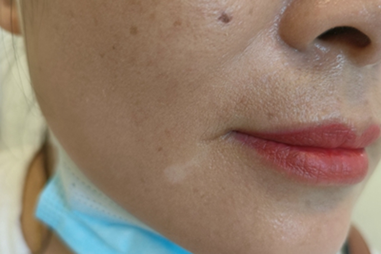 进展期节段型白癜风口周白斑图 进展期节段型白癜风口周白斑图