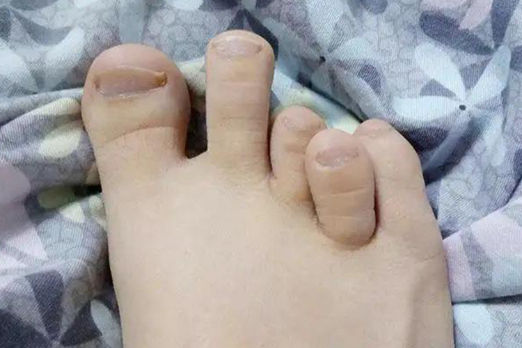 脚趾缺失缺趾畸形图