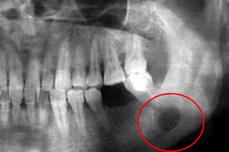 下颌骨骨化纤维瘤影像学图