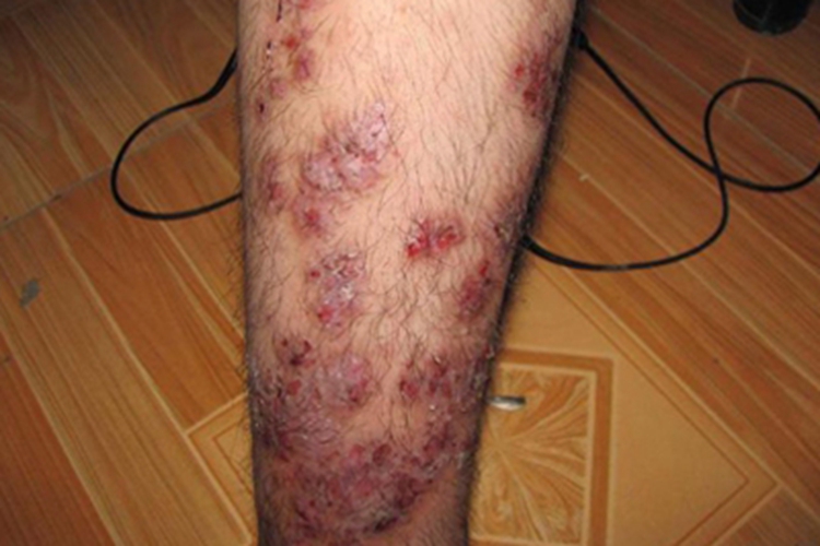 结节性痒疹小腿症状图