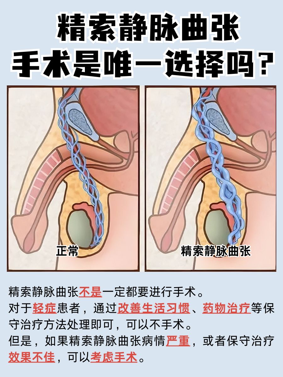 精索静脉曲张：手术是唯一选择吗？