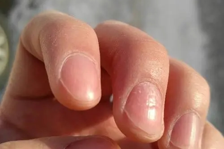 营养缺乏导致中指指甲波浪纹图
