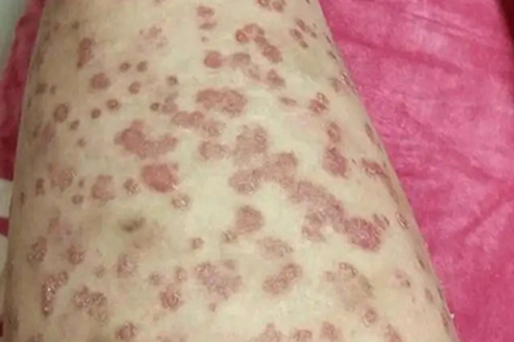 点滴型副银屑病脱屑图