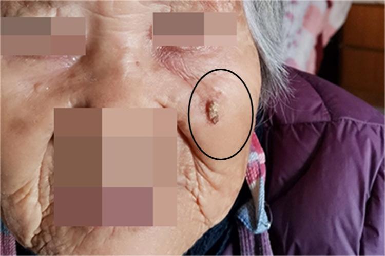 角化棘皮瘤面部粗糙图 角化棘皮瘤面部粗糙图