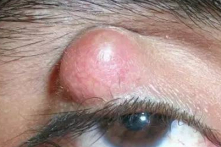 霰粒肿上眼皮巨大红色疙瘩图 霰粒肿上眼皮巨大红色疙瘩图