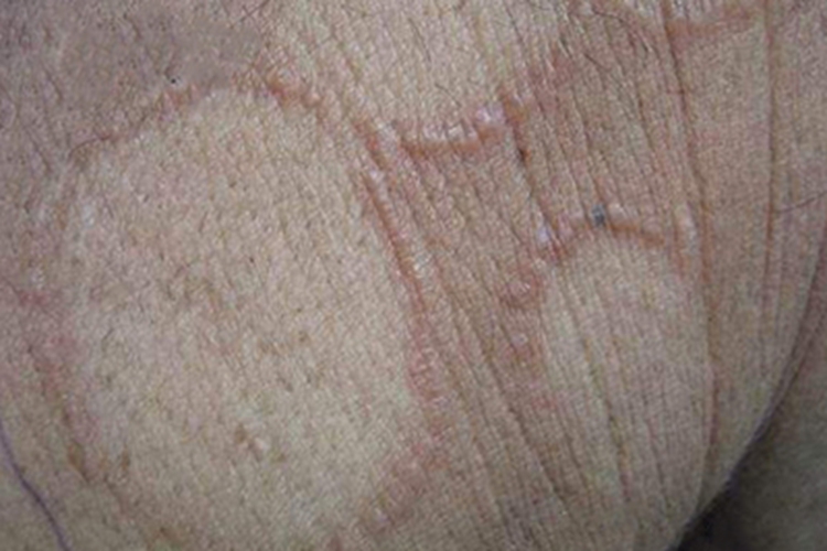 泛发型环状肉芽肿臀部症状图 泛发型环状肉芽肿臀部症状图