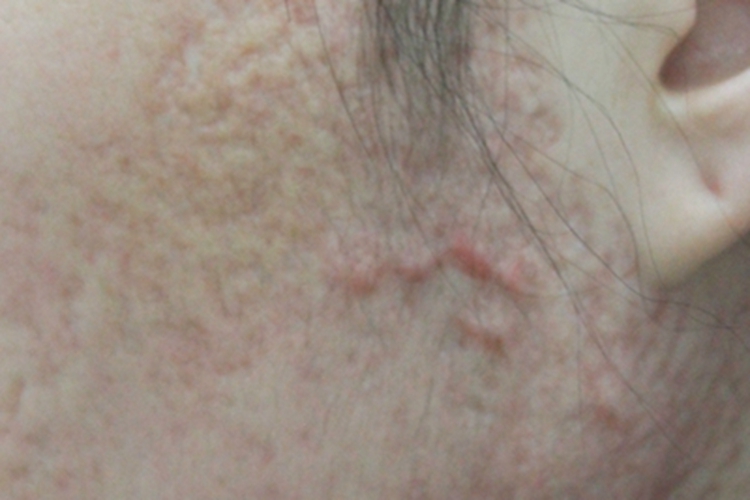 聚合性痤疮面部遗留瘢痕图