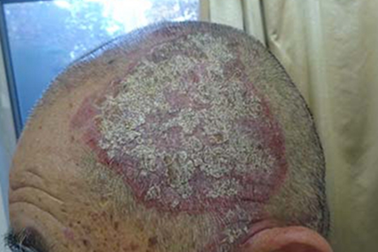 寻常型银屑病头皮起白皮图