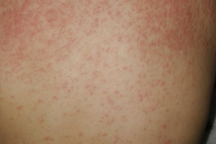 痱子背部小疙瘩图