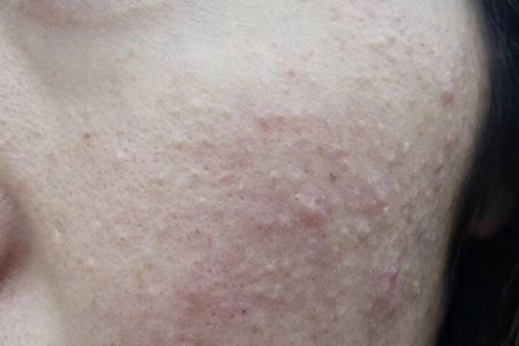 寻常痤疮面部疙瘩图 寻常痤疮面部疙瘩图