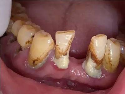 急性坏死性龈口炎下牙龈萎缩溃烂图