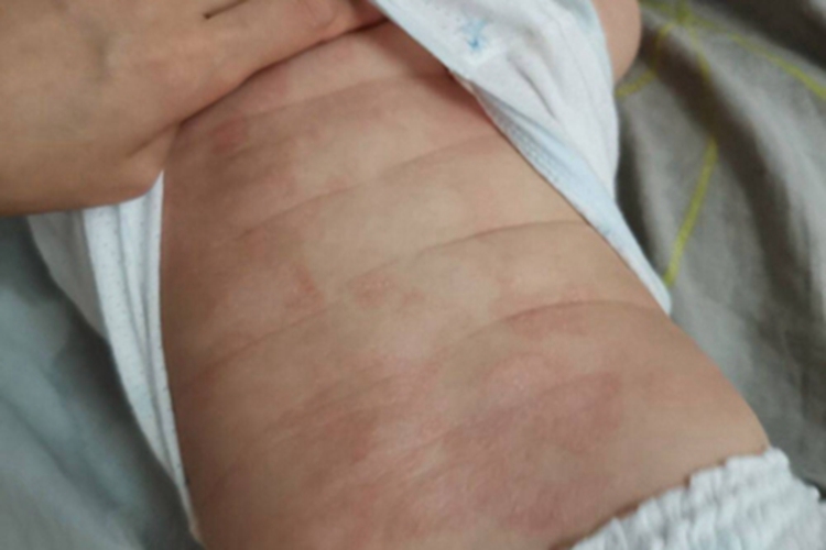 渗出型婴儿湿疹背部症状图