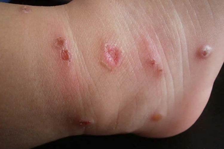 儿童丘疹性荨麻疹图 儿童丘疹性荨麻疹图