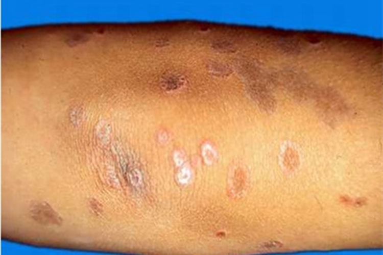 扁平苔藓样接触性皮炎胳膊脱屑图