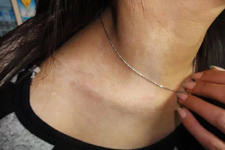 脖子无色素痣白块图 脖子无色素痣白块图