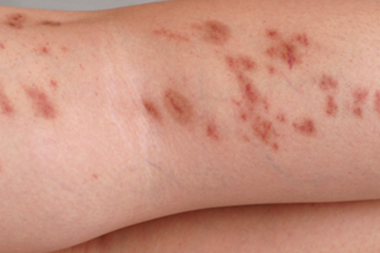 金黄色苔藓腿部斑图