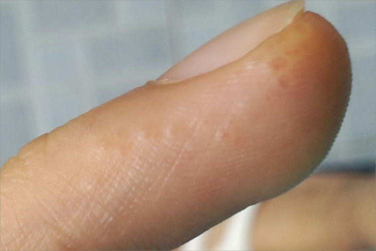 水疱型手癣手指症状图