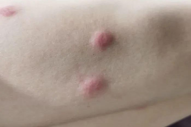 蚁酸过敏风团图