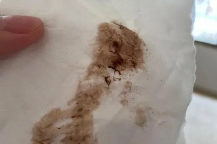 胎盘早剥褐色分泌物图