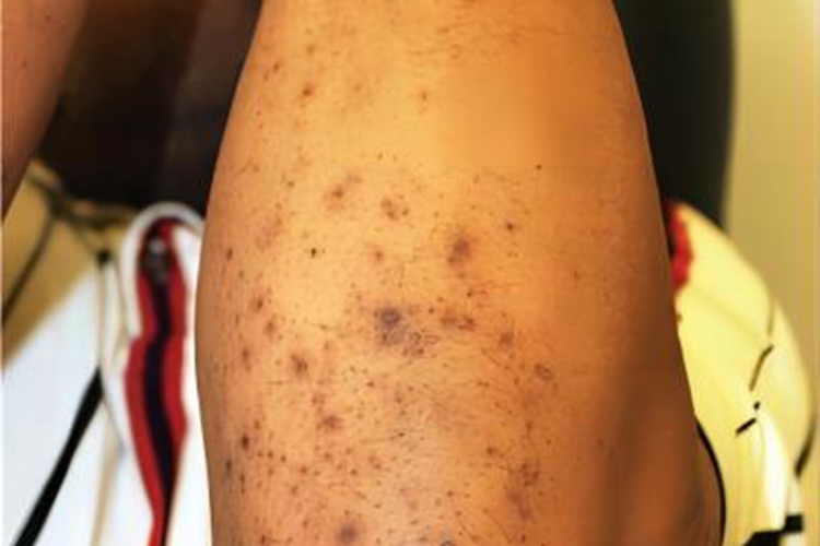 反应性穿通性胶原病胳膊硬疙瘩图