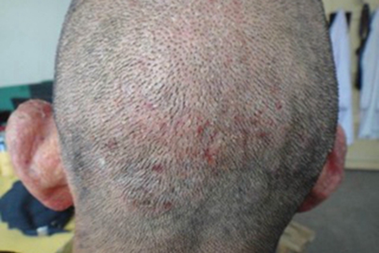 光化性痒疹头皮红点图