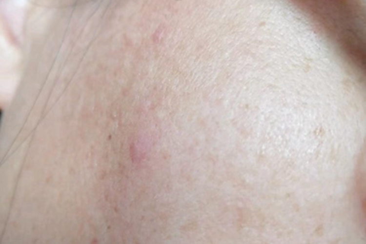 过敏性皮炎面部长疙瘩图