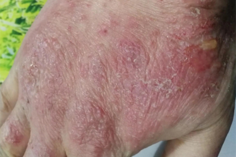 光毒性接触性皮炎手背水疱图 光毒性接触性皮炎手背水疱图