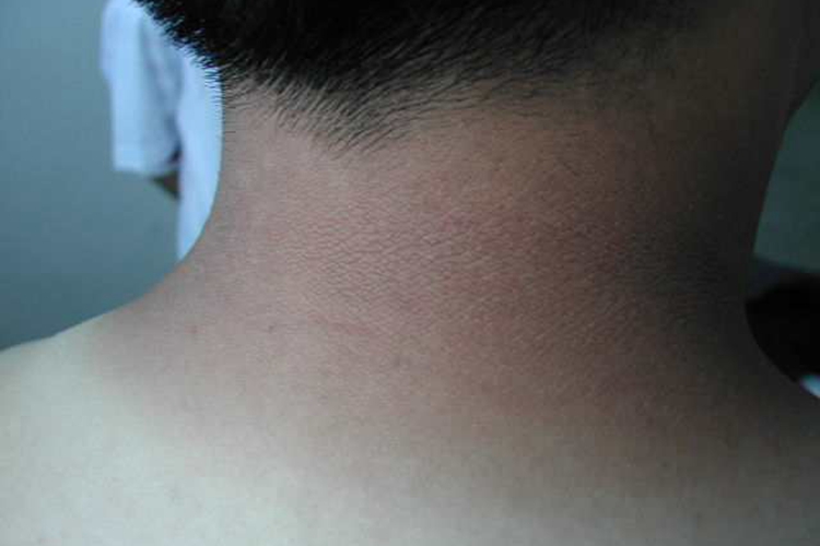 小孩脖子炎症后黑变病图