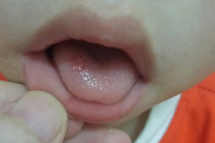 鹅口疮早期症状图