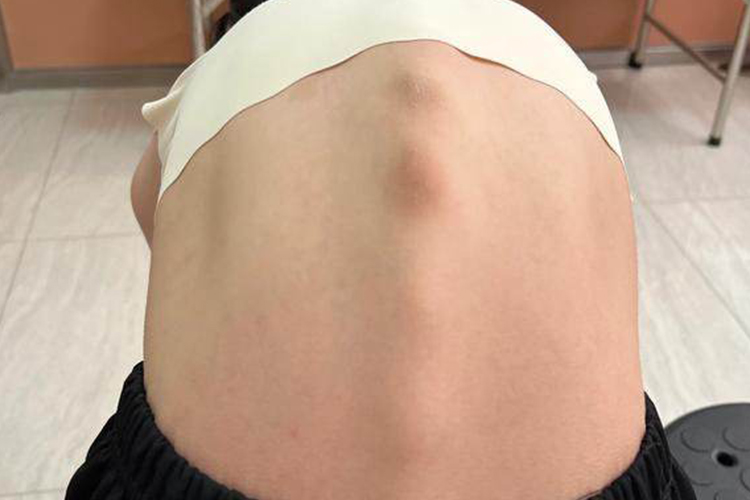 太瘦了背部脊柱突出图 太瘦了背部脊柱突出图