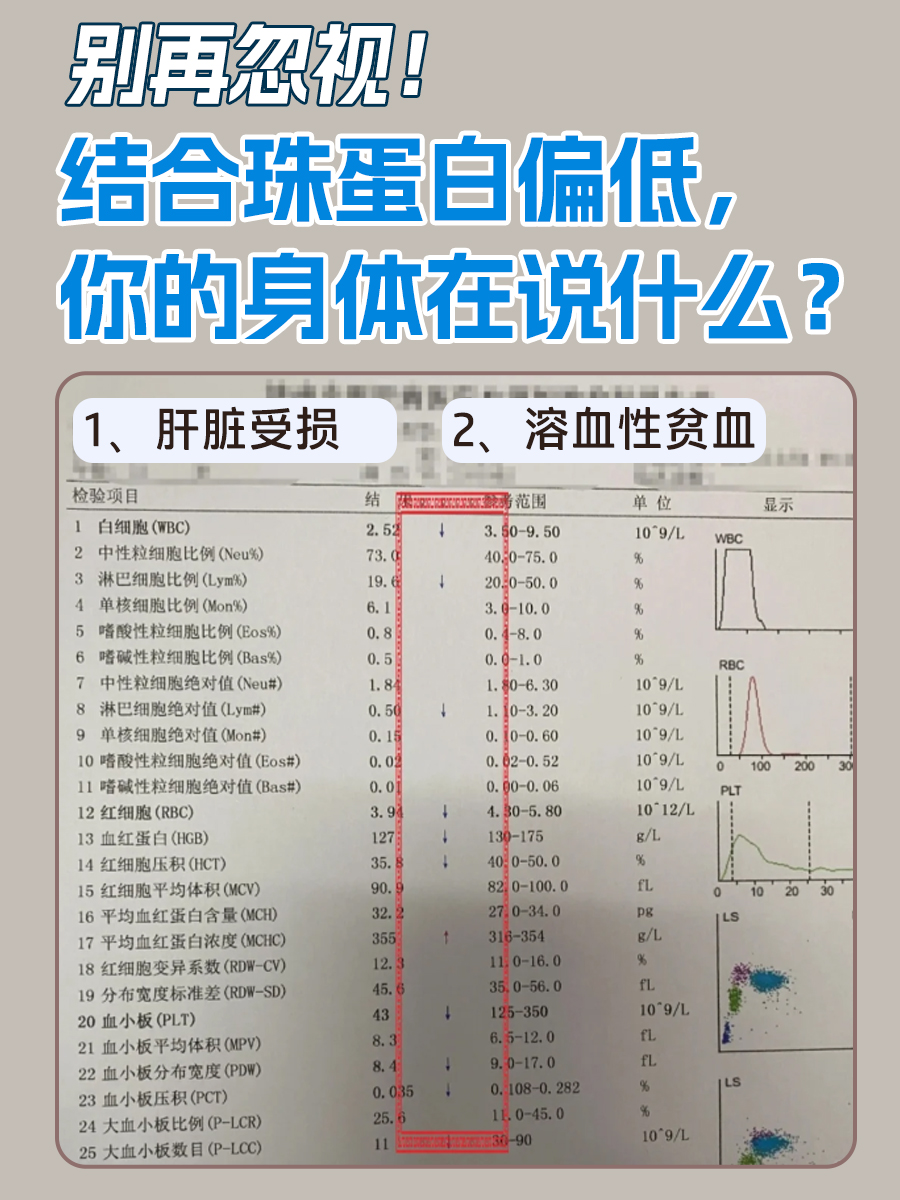 别再忽视!结合珠蛋白偏低,你的身体在说什么?