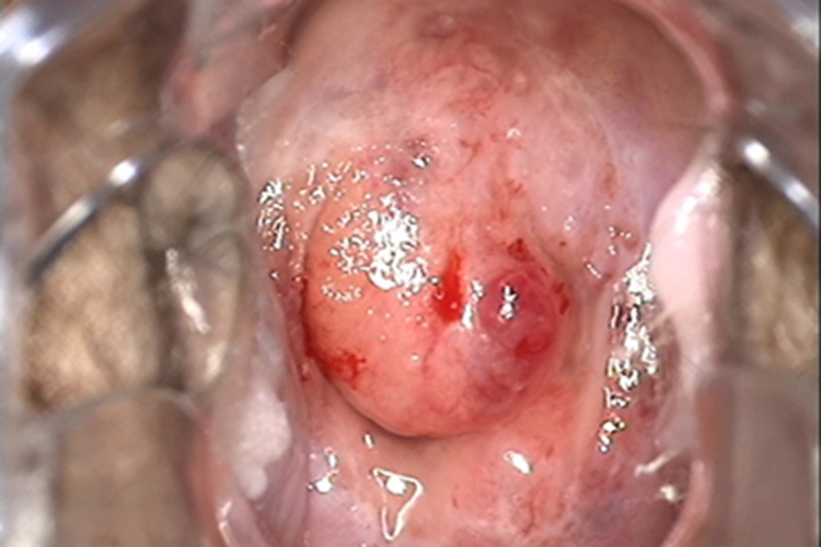 宫颈囊肿症状图