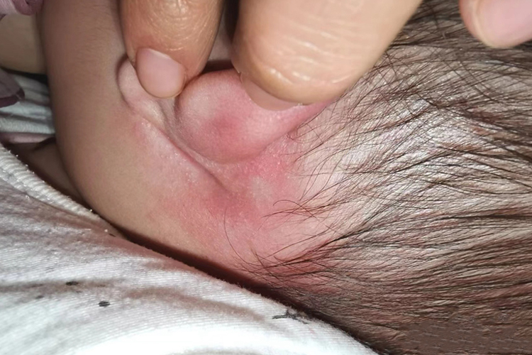 宝宝耳朵后湿疹图