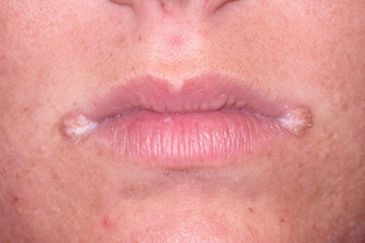 营养不良性口角炎症状图 营养不良性口角炎症状图