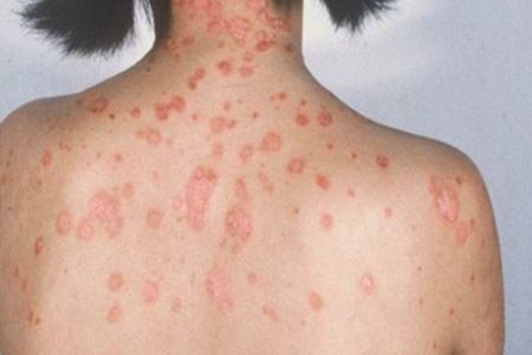 寻常型银屑病背部症状图