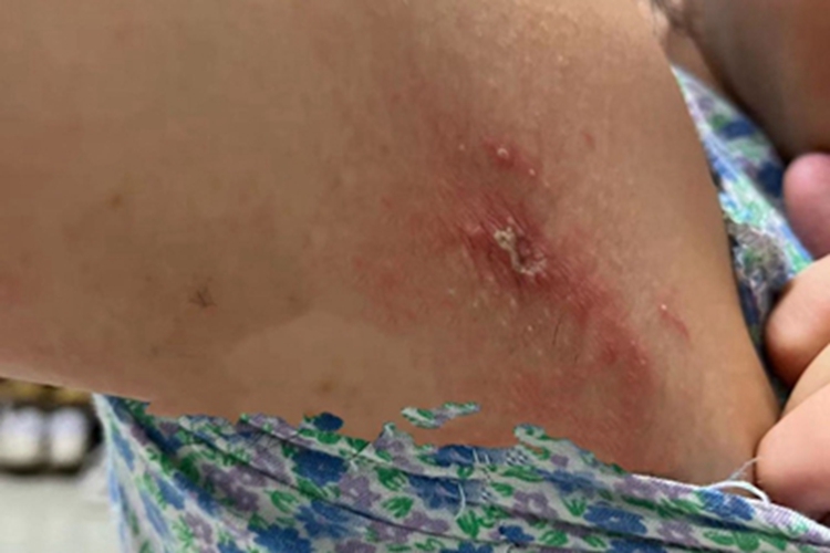 刺毛虫皮炎小疙瘩图 刺毛虫皮炎小疙瘩图